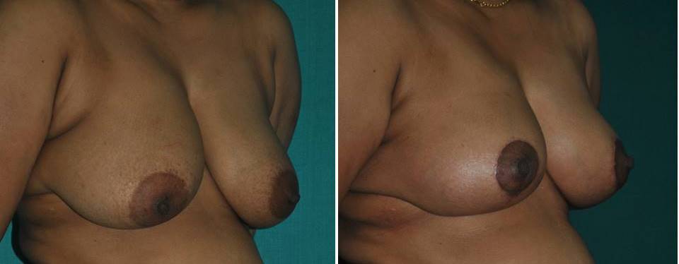Breast uplift surgery in India